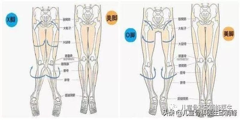 八字腿是因为什么原因导致的(造成内八外八的原因)